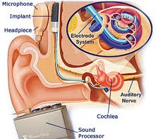 Alojamiento del implante en el sistema auditivo