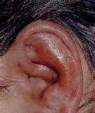 ¿Qué es la pericondritis auricular?