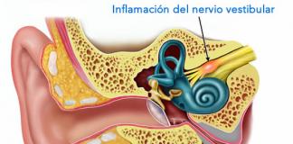 La neuritis vestibular y la inflamación del nervio